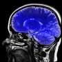 New study provides first evidence of dopamine system injury in the brain of long COVID patients