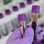 Biomarkers could help identify ICU patients at risk of chronic critical illness