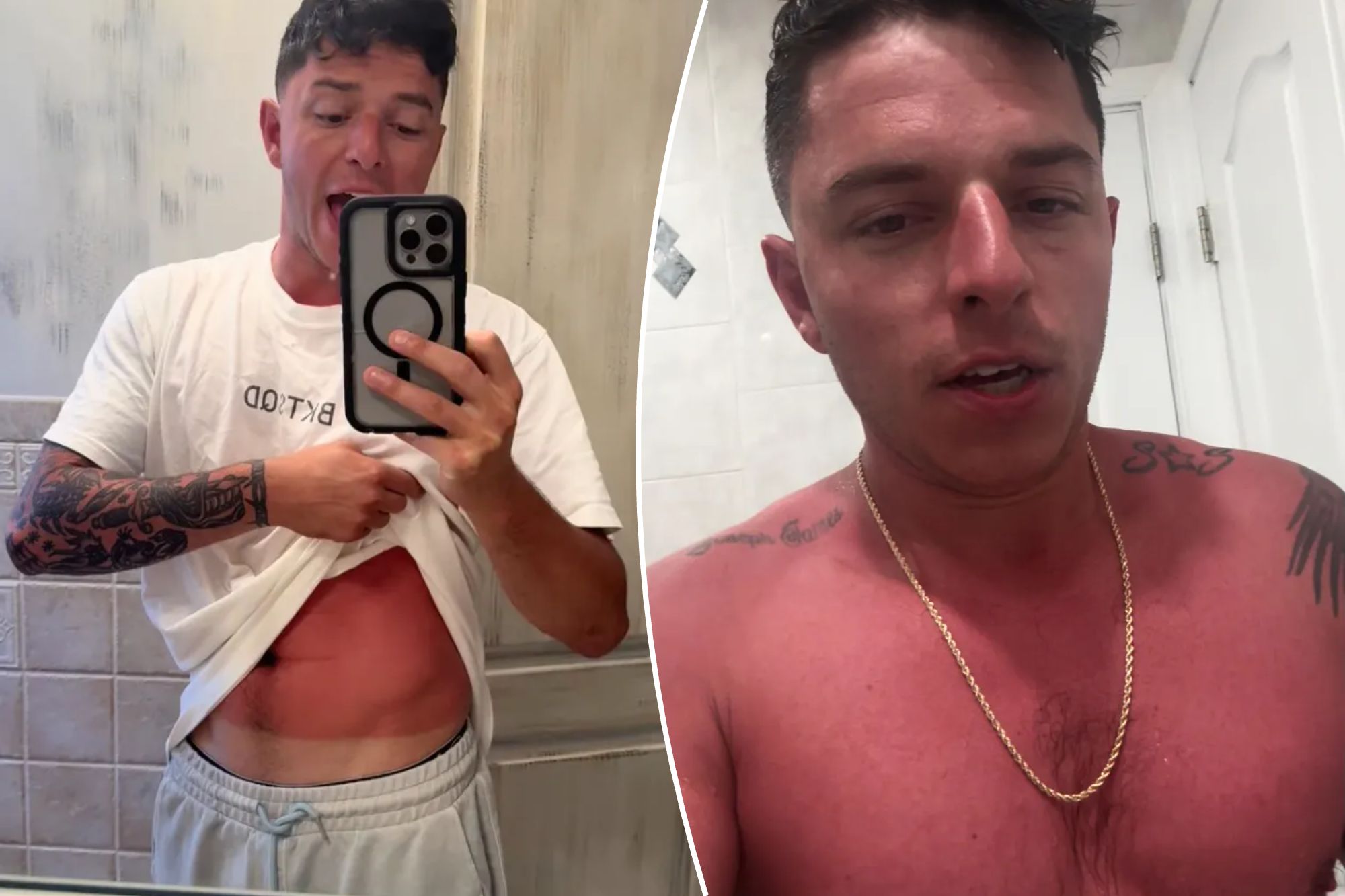 Can a ‘life-changing sunburn’ really give you cancer? The scary reality of skipping SPF