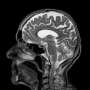 Brain MRI surveillance without prophylactic cranial irradiation improves cognitive outcomes in small cell lung cancer