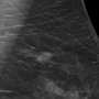 Tomosynthesis detects breast cancer more frequently during screening