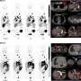 Next generation theranostic pair offers new strategy to detect and treat metastatic kidney cancer