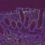 Cystic fibrosis: Triple therapy is particularly effective in early childhood