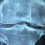Call for systematic bone health optimization before joint replacement and spinal fusion surgery