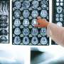 Advanced MRI data set maps adolescent brain development
