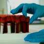Blood test can help clinicians better identify brain injury severity in patients