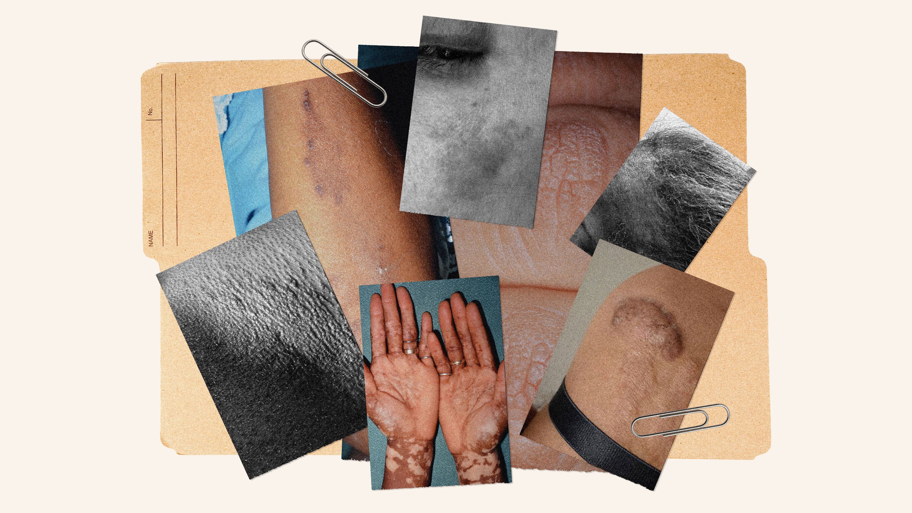 11 Common Skin Conditions on Dark Skin and How to Treat Them