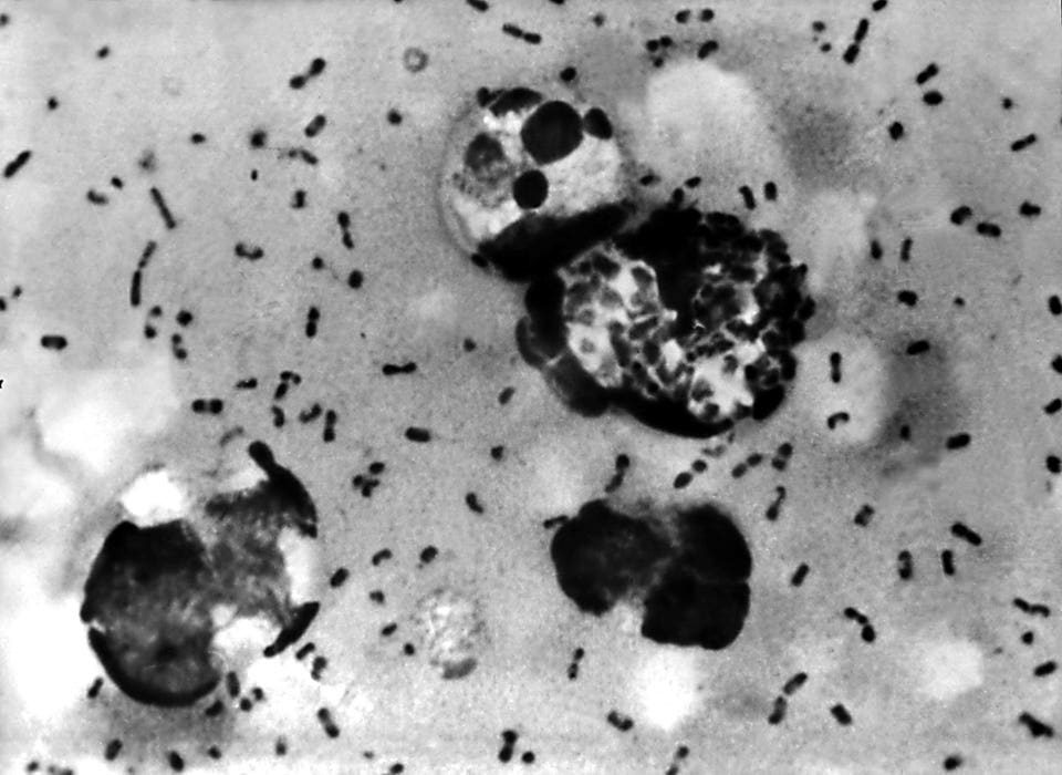 Russian Lab Death Raises Questions About Pneumonic Plague: What Americans Need To Know