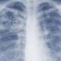 Study suggests the threat of mold-associated illnesses may be underappreciated