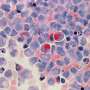Mapping the diversity of chronic lymphocytic leukemia at single-cell resolution