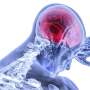 First-of-its-kind trial tests low-dose radiation to target brain inflammation in Parkinson's disease