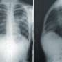 Twice-daily radiation linked to better quality of life in lung cancer trial